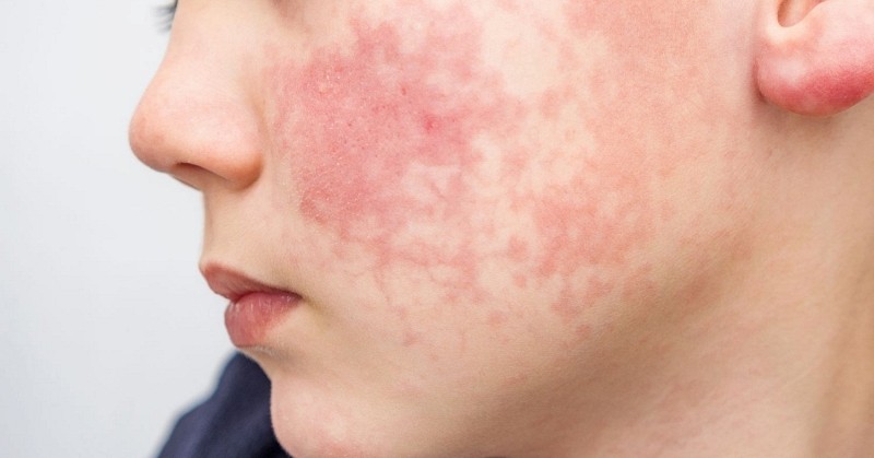 8 dấu hiệu ban đầu của "căn bệnh dễ lây lan nhất thế giới": Xuất hiện TRƯỚC cả khi phát ban, trẻ dưới 5 tuổi có nguy cơ cao nhất